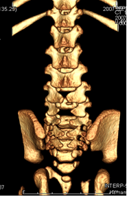 二分脊椎の3D-CT